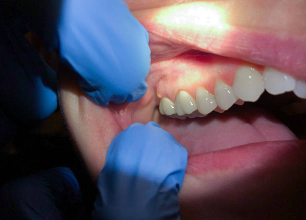 Best Lost Filling or Crown Replacement in Shongopovi, AZ