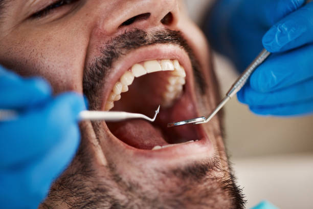 Best Knocked-Out Tooth (Avulsed Tooth) Treatment in Shongopovi, AZ